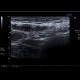 Crohn's disease of terminal ileum: US - Ultrasound